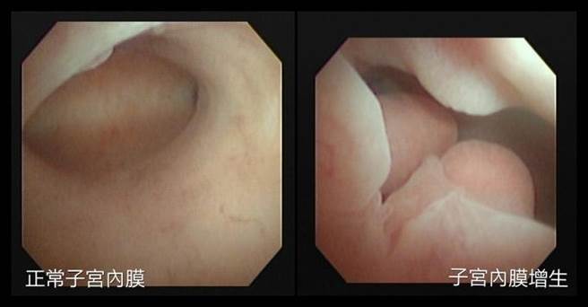 亚大附医妇产部生殖医学科主任刘邦斌指出，肥胖或体脂肪过高都会增加子宫内膜增生发生率，务必减少吃油炸或过度精致的食物，尤其建议维持每周运动5次规律运动。（亚大附医提供／潘虹恩台中传真）