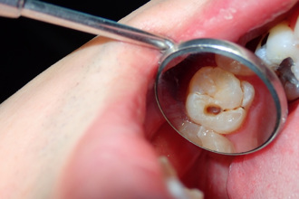 30歲竹科男滿口爛牙、長膿包 這習慣害的！醫警告恐口腔病變