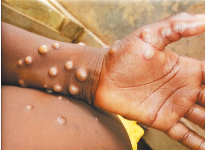 国内首见2起猴痘本土个案，分别为40多岁、20多岁男子，上月出现发烧、丘状痒疹、水泡、淋巴结肿大等症状后，陆续确诊猴痘，2人目前隔离治疗中。（取自世界卫生组织）