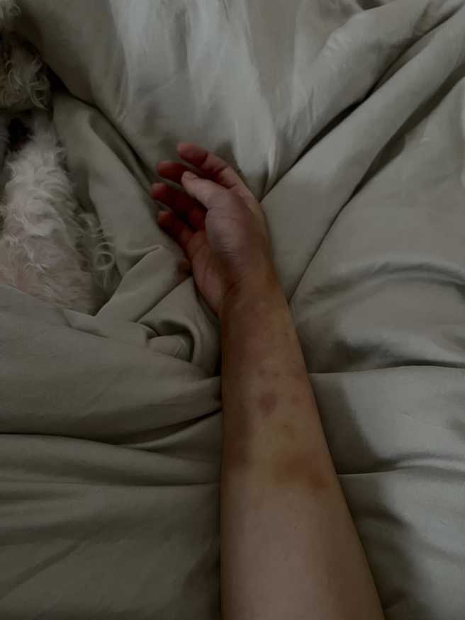 舒子晨跟教练练完球，手布满瘀青。(图/舒子晨 FB)