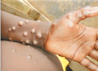 猴痘疫苗加購1萬劑 擴大接種3族群