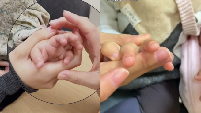 李亚鹏女儿手指严重脱皮。(图/海哈金 抖音)