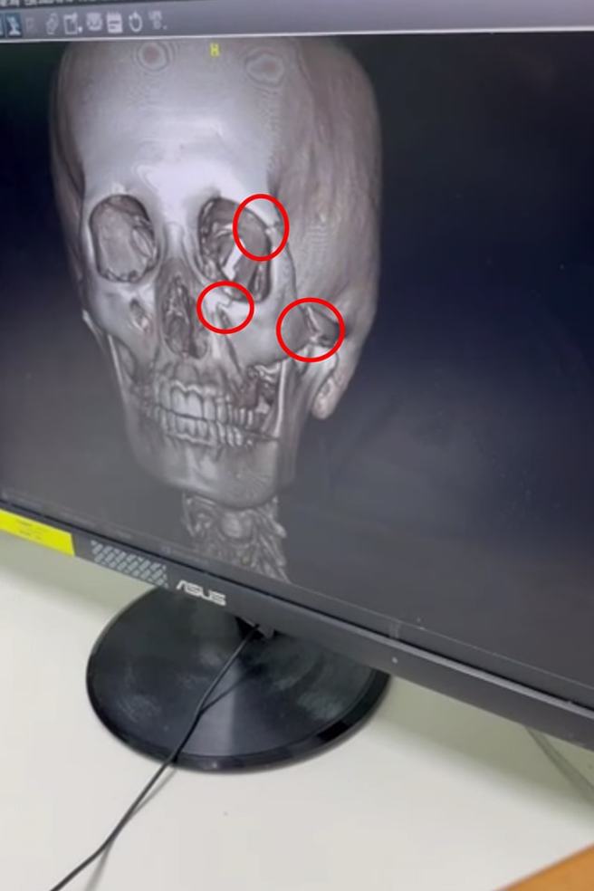 宋燕旻透露脸骨断了三处。（图／宋燕旻facebook）