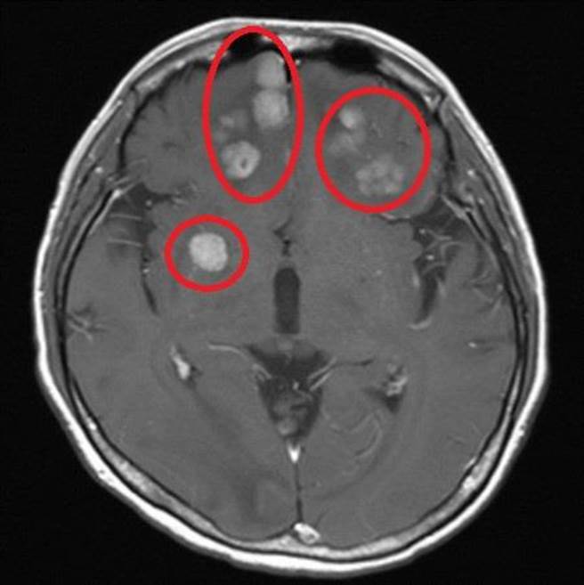 电脑断层显示，患者尚未接受抗体复合药物治疗前，脑部扩散的癌细胞。（台北慈济医院提供）