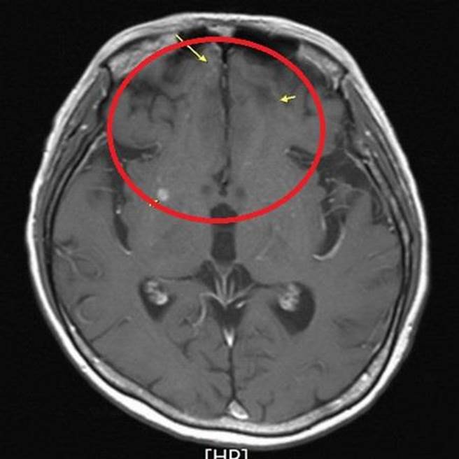 经抗体复合药物治疗后，脑部转移的癌细胞明显缩小。（台北慈济医院提供）