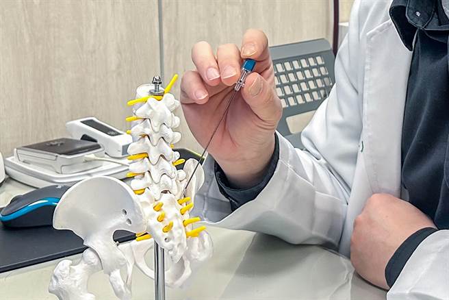 高频热凝手术是将导针置入所需治疗的神经周围，利用高频电波传递能量达到止痛效果。（罗浚滨摄）