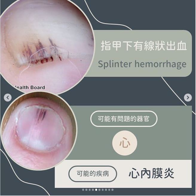 指甲下有线状出血。(图/ 黄晨昊授权提供)