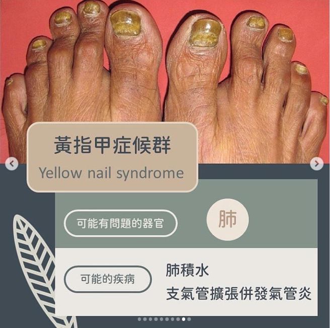 黄指甲症候群（Yellow nail syndrome）。(图/ 黄晨昊授权提供)