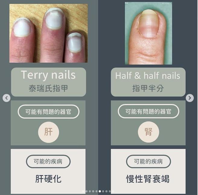 指甲半分（Half & half nails）(图右)。(图/ 黄晨昊授权提供)
