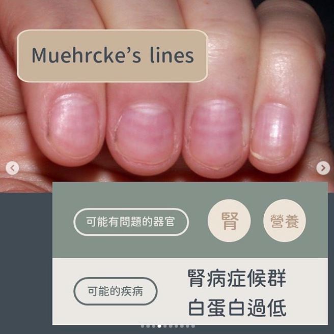 Muehrcke’s line。（图／黄晨昊授权提供）