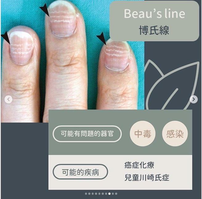 博氏线（Beau’s line）。（图／黄晨昊授权提供）