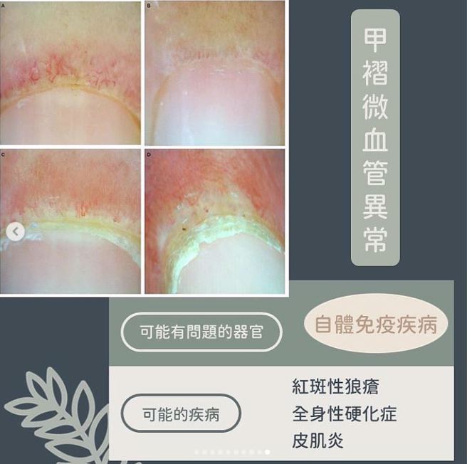 甲褶微血管异常。（图／黄晨昊授权提供）