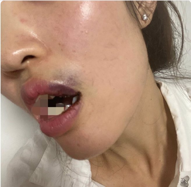 吴翰前女友先前指控男方家暴，更曝光她的嘴角溅血瘀青照。(图／撷取自微博）