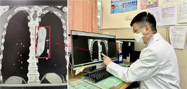 病人经电脑断层，检查影像显示主动脉破裂剥离。（台大新竹医院提供／陈育贤新竹传真）