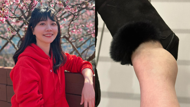 民进党立委高嘉瑜访美不慎受伤，除了脚踝肿的像麵龟，小腿处还留下一道血痕，（合成图／翻摄自高嘉瑜脸书）