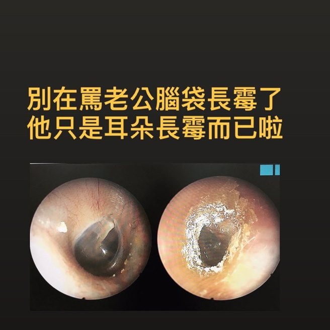 霉菌性外耳道炎（图右）是外耳道遭霉菌感染。(图/ 张益豪授权提供)