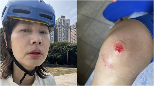 丁寧晒出因摔车而导致的伤口照。(图／翻摄自丁寧脸书)