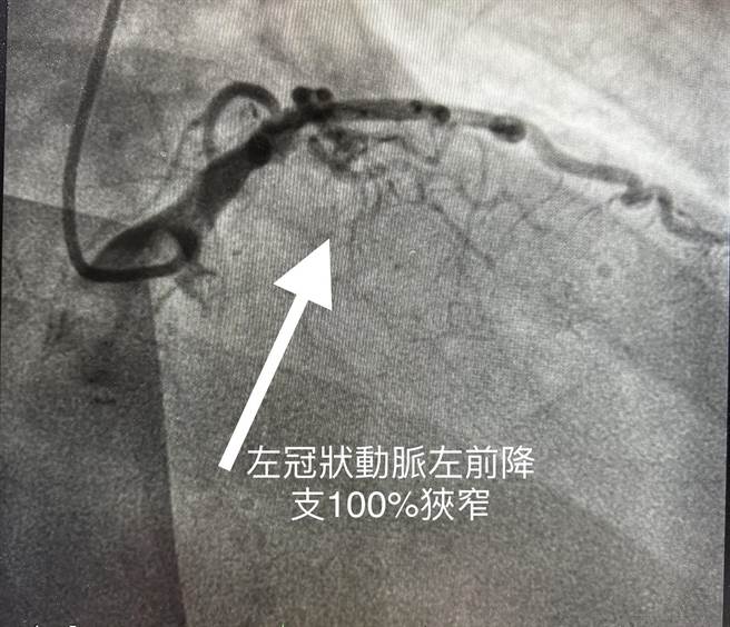 左冠状动脉左前降支100％阻塞。（新北联医提供）