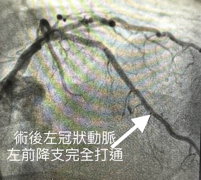 左冠状动脉左前降支完全打通。（新北联医提供）