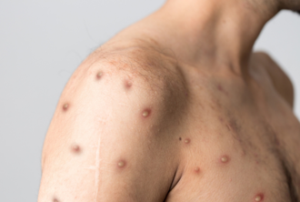 苗栗縣出現首例本土猴痘個案 有這些症狀盡速就醫