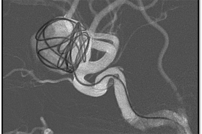 阮医师成功以血流导向装置辅助线圈的方式治疗动脉瘤。（台北慈济医院提供）