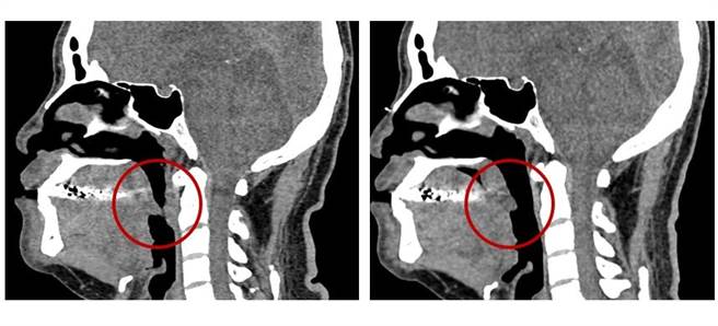 蔡先生治疗前（左图）、后（右图）呼吸道对比。（台中医院提供／潘虹恩台中传真）
