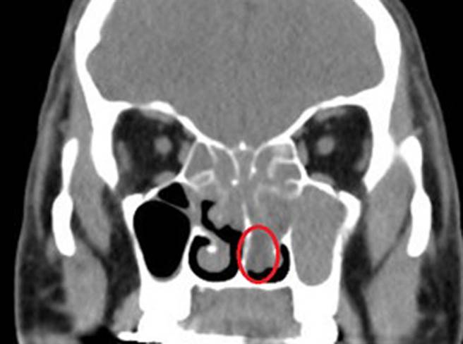 一名男子长期失去嗅觉，就医发现一长串「白葡萄」塞满鼻腔。(屏东荣总提供)