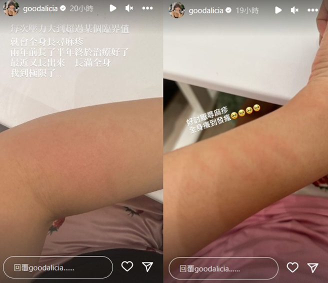 爱莉莎莎在IG上晒出身上长满荨麻疹的照片。(图／翻摄自爱莉莎莎IG@goodalicia)