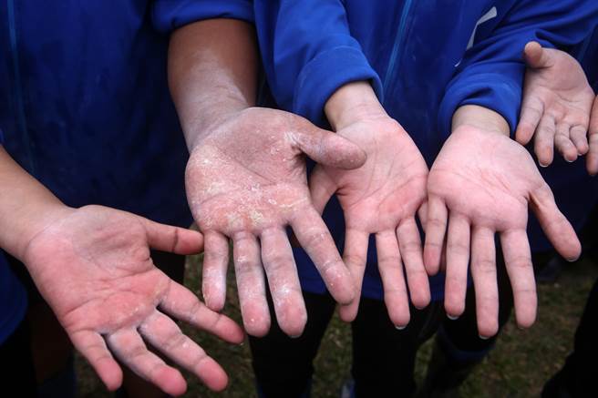 112年全国原住民族运动会27日在观山河滨公园举行 传统拔河项目最后一天赛程，胜利队伍秀出长水泡的双手。（邓博仁摄）