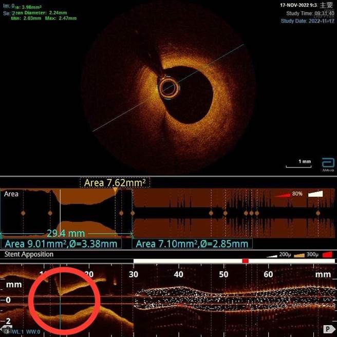 大里仁爱医院心臟内科主任方修御说明，血管内光学相干电脑断层（OCT）是利用远红外线的方式，再加上把红血球暂时移开血管来看清楚血管构造，进而改善预后。（大里仁爱医院提供／潘虹恩台中传真）