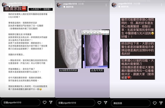 优格姐姐透露因骨头生长情况不佳，医生说要挖骨。（图／yogurtlin1010 Instagram）