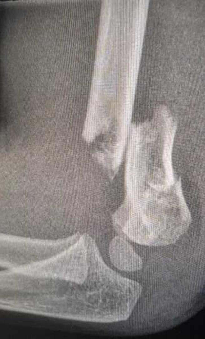 男童的骨头永久性长歪。（图／翻摄自新明日报）