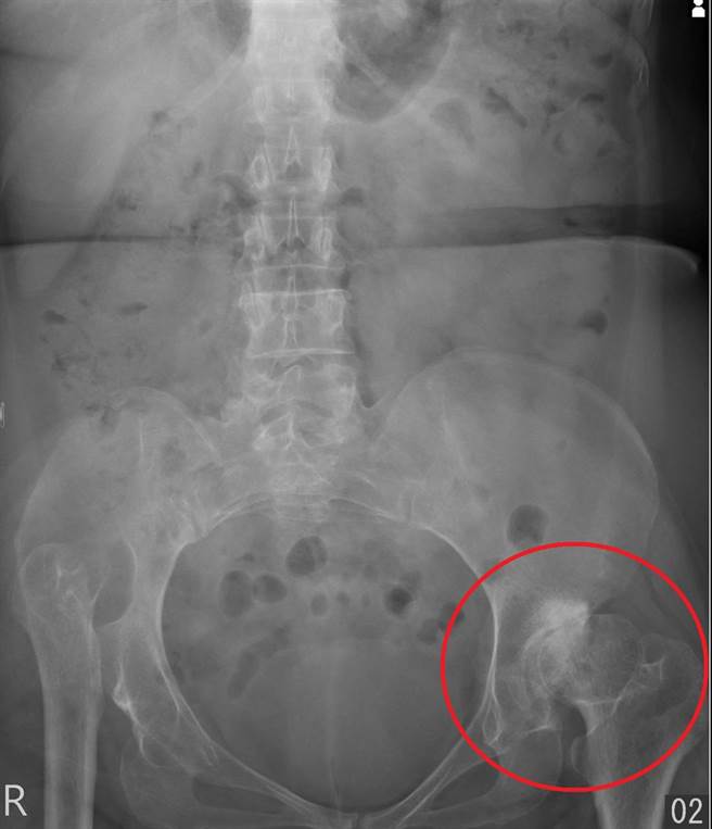 林女士双侧都患有髋关节发育不良，左侧的髋关节软骨严重磨损，关节间隙几乎完全丧失。（长安医院提供／冯惠宜台中传真）