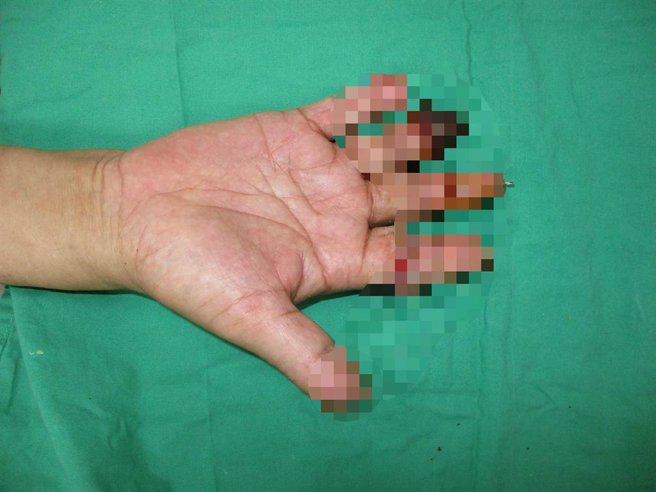 云林叶姓鸡农日前右手五指遭饲料机绞断，送嘉义大林慈济医院抢救接回。（大林慈济医院提供／邱显诚嘉义传真）