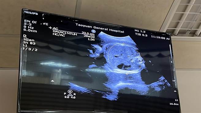 產婦產後心情低落容易在產後7天因荷爾蒙改變發生，之後多數會緩解，但有產婦不會隨著時間改善，醫師建議尋求專業協助。（讀者提供）