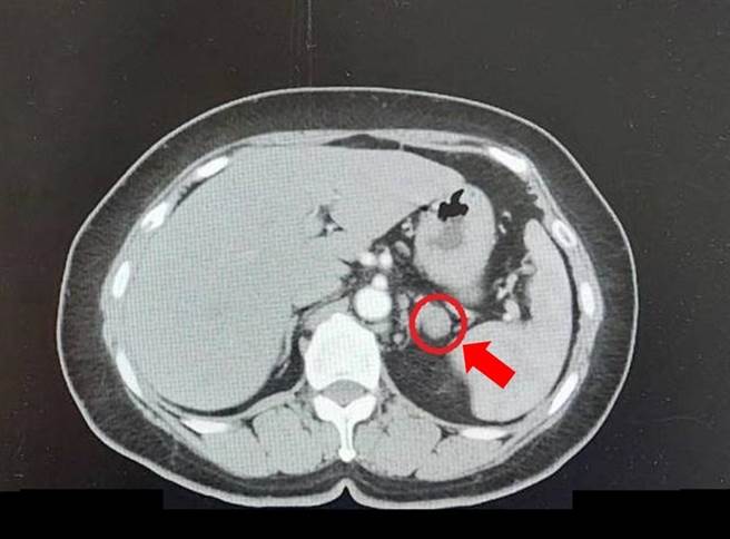 邱女因腎上腺腫瘤(紅圈處)影響血壓問題，手術治療後獲得大幅改善。（大千醫院提供／謝明俊苗栗傳真）