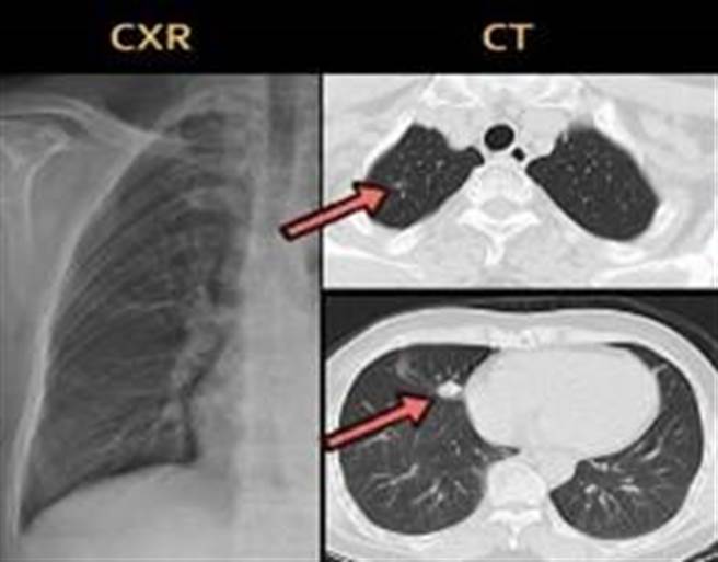 林妇的右上肺叶有一颗0.4公分的微浸润腺癌、右中肺叶有颗1.2公分的肺腺癌。（高市阮综合医院提供／杨舒婷高雄传真）