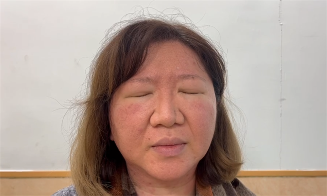 由于眼睛最多睁开一条细缝，林小姐看电脑萤幕工作非常吃力，生活也难以自理。（耕莘医院提供／林周义台北传真）