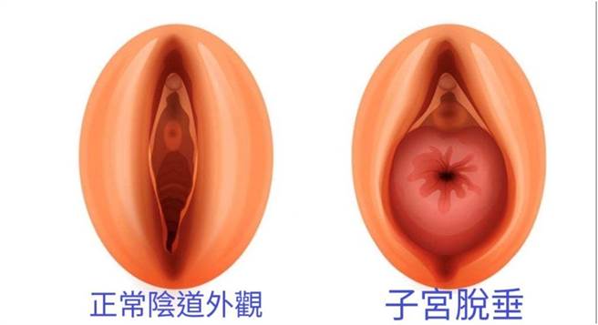 大里仁爱医院妇产科医师李伊菱表示，骨盆腔器官脱垂常见于多次自然产且年纪大的女性，肥胖、长期负重会使腹内压上升，加上老化导致贺尔蒙下降、肌肉与胶原蛋白流失，容易让骨盆腔的器官从变弱的阴道壁膨出来。（大里仁爱医院提供／潘虹恩台中传真）