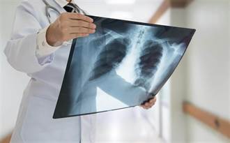 急！肺癌標靶藥缺貨 醫：病人停用壽命恐少半年～1年