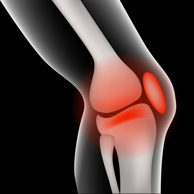 发炎太久的话就不好，反而会影响到健康的细胞。不知为何，免疫系统收到了错误讯息，除了攻击受损细胞，连附近的正常细胞也被波及。(示意图/shutterstock)