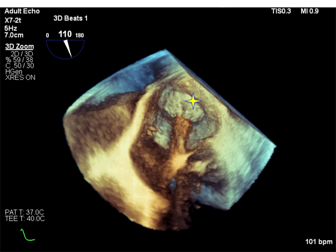 为降低对显影剂过敏或慢性肾病变不适合注射显影剂的病人术中风险，藉经食道超音波技术代替显影剂注射，可清楚观察冷冻消融球囊与肺静脉的密合度（星号处）。（新竹台大分院提供／邱立雅竹县传真）