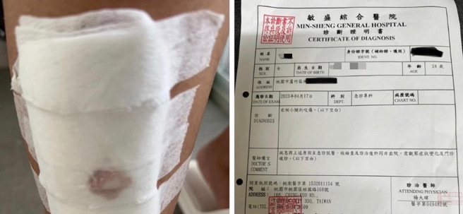 蘆竹區有民眾表示，山鼻站附近流浪狗多，甚至有時候還會追車，前幾天下班途中被狗咬傷，拍下腿部傷口照PO網控訴。（民眾提供／陳夢茹桃園傳真）