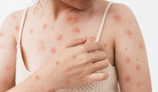 网传外籍女看护照顾阿嬷也感染猴痘，指挥中心回应了。（图／shutterstock）