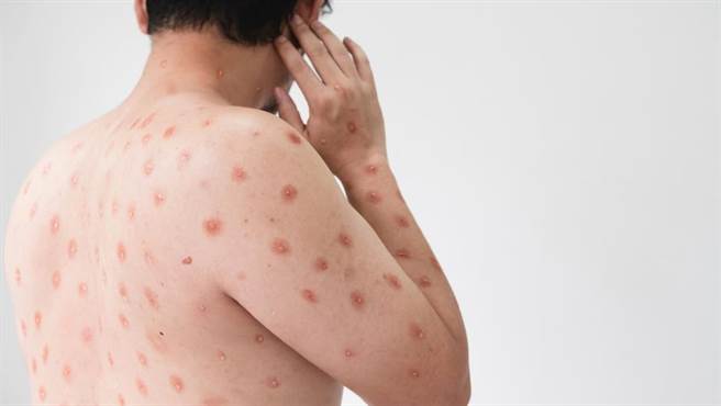 新冠疫情逐漸趨緩後，猴痘卻接踵而來，根據衛福部統計，台灣到4月中旬已經累積超過25例猴痘個案，其中4例從未出過國，屬於本土案例。（示意圖／達志影像）