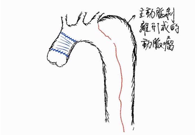 主动脉剥离形成的肿瘤。（门诺医院提供／罗亦晽花莲传真）