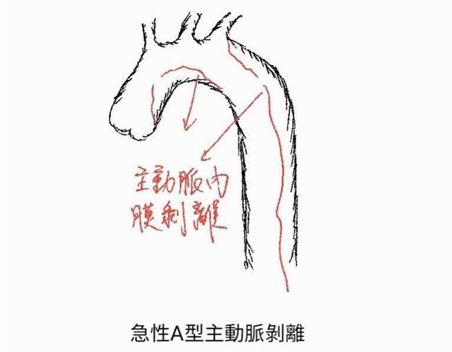 急性A型主动脉剥离。（门诺医院提供／罗亦晽花莲传真）