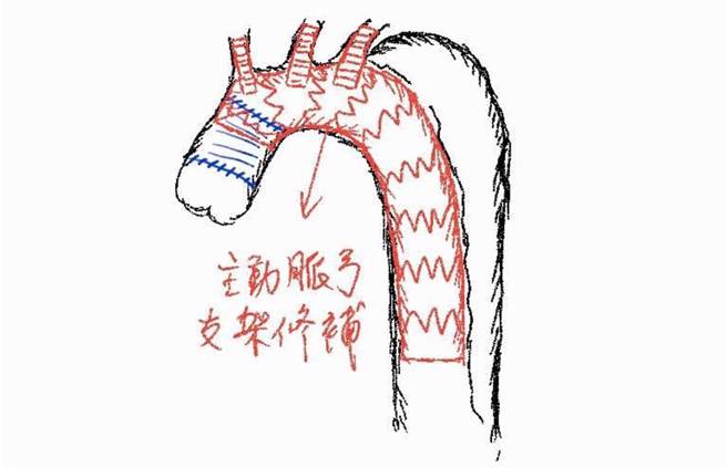 主动脉弓支架修补。（门诺医院提供／罗亦晽花莲传真）
