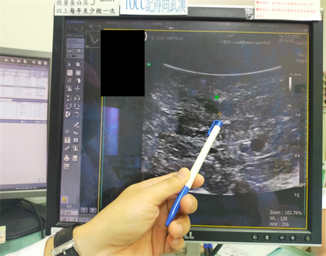 雁捷医师指出，腹腔镜搭配术中超音波，可以更明显观察肝胰肿瘤。（部苗医院提供／李京升苗栗传真）