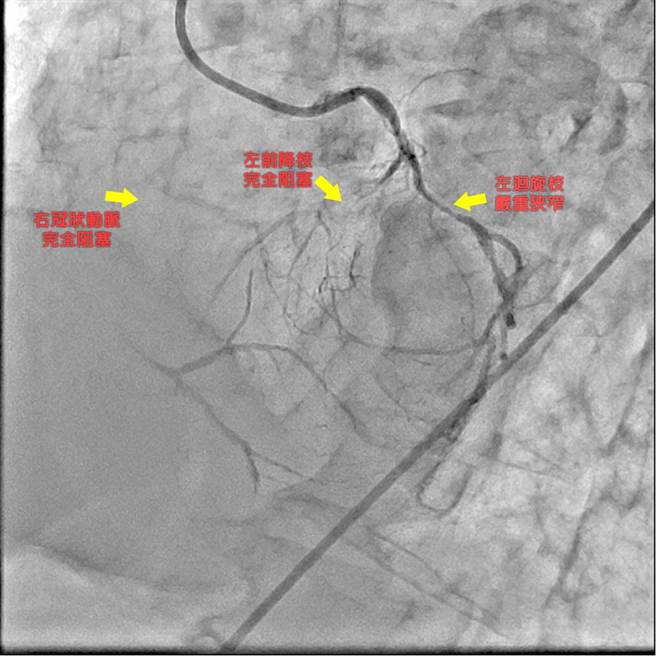 68岁工人突发心肌梗塞，幸经心臟内外科团队合作进行心臟血管绕道手术，成功抢回生命。（澄清医院中港院区提供／潘虹恩台中传真）